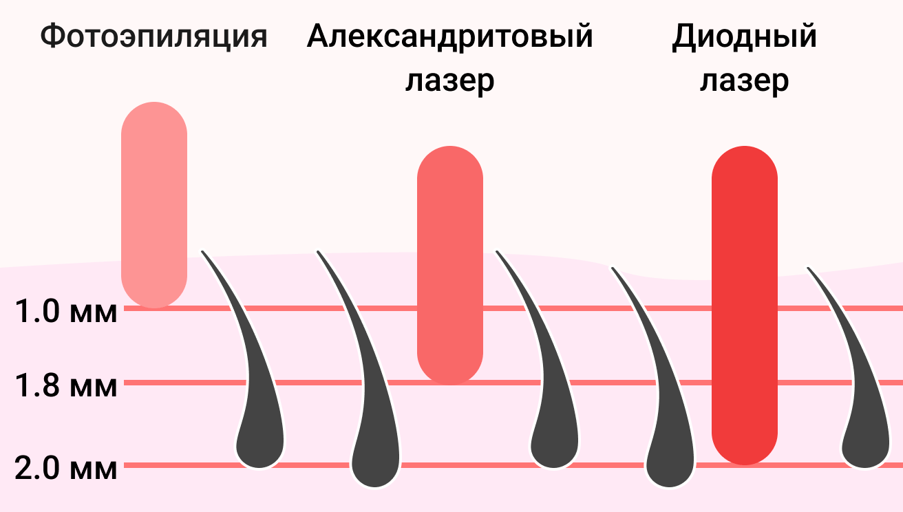 Преимущества диодного лазера